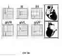 Fig. 17 - Diagnostic method utilizing standard lead ECG signals
