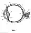 Fig. 02 - Glaucoma implant with extending members
