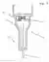 Fig. 06 - Safety indwelling needle