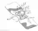 Fig. 01 - Securement device for indwelling catheters or introducers