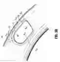 Fig. 04 - Urology catheter