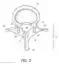 Fig. 04 - System and method for protecting neurovascular structures