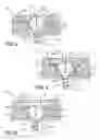 Fig. 03 - Polyaxial locking screw plate assembly