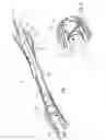 Fig. 10 - Device for removing an elongated structure implanted in biological tissue