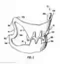 Fig. 02 - Apparatus for compressing body tissue