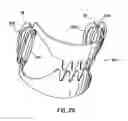 Fig. 28 - Apparatus for compressing body tissue