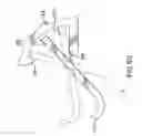Fig. 49 - Apparatus for compressing body tissue