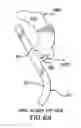 Fig. 67 - Apparatus for compressing body tissue