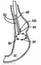 Fig. 01 - Methods and devices for reducing hollow organ volume