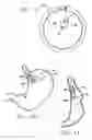 Fig. 06 - Methods and devices for reducing hollow organ volume