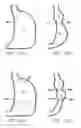 Fig. 07 - Methods and devices for reducing hollow organ volume