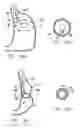 Fig. 09 - Methods and devices for reducing hollow organ volume