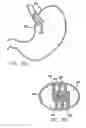 Fig. 28 - Methods and devices for reducing hollow organ volume