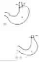 Fig. 04 - Methods and devices for reducing hollow organ volume