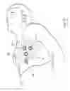 Fig. 22 - Methods and devices for placing a conduit in fluid communication with a target vessel and a source of blood