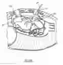 Fig. 24 - Methods and devices for placing a conduit in fluid communication with a target vessel and a source of blood