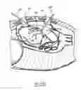 Fig. 25 - Methods and devices for placing a conduit in fluid communication with a target vessel and a source of blood