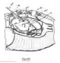 Fig. 27 - Methods and devices for placing a conduit in fluid communication with a target vessel and a source of blood