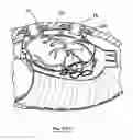 Fig. 28 - Methods and devices for placing a conduit in fluid communication with a target vessel and a source of blood