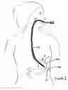 Fig. 02 - Method and device for use in minimally invasive placement of intragastric devices