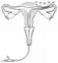 Fig. 01 - Contraceptive with permeable and impermeable components