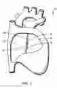 Fig. 02 - Devices, systems, and methods for closure of cardiac openings