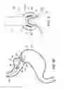 Fig. 06 - Methods and apparatus for creating and regulating a gastric stoma