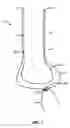 Fig. 02 - Soft tissue suspension for cosmetic surgery