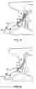 Fig. 09 - Welding systems useful for closure of cardiac openings