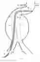 Fig. 09 - Apparatus and method for the articulation of a catheter