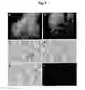 Fig. 02 - Xenograft model of functional normal and malignant human breast tissues in rodents and methods thereof