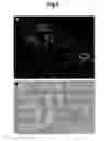 Fig. 04 - Xenograft model of functional normal and malignant human breast tissues in rodents and methods thereof