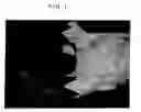Fig. 08 - Appliance for adjusting points of upper body in good limb