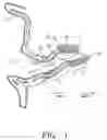 Fig. 02 - Semi-permanent canal hearing device