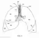 Fig. 04 - Methods and devices for blocking flow through collateral pathways in the lung