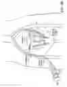 Fig. 05 - Embolization