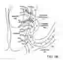 Fig. 06 - Embolization