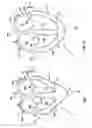 Fig. 02 - Delivery of cardiac constraint jacket