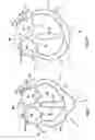 Fig. 03 - Delivery of cardiac constraint jacket