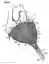 Fig. 08 - Delivery of cardiac constraint jacket