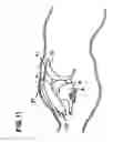Fig. 10 - Delivery of cardiac constraint jacket
