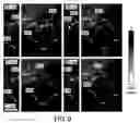 Fig. 10 - System and method for ECG-triggered retrospective color flow ultrasound imaging