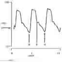 Fig. 02 - Device for determining a characteristic point in the cardiac cycle