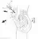 Fig. 02 - Safety trocar device