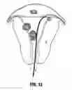 Fig. 10 - Method and system for photoselective vaporization for gynecological treatments
