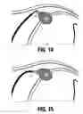 Fig. 11 - Method and system for photoselective vaporization for gynecological treatments