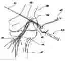 Fig. 01 - Method and implant for securing ligament replacement into the knee