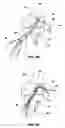 Fig. 04 - Method and implant for securing ligament replacement into the knee