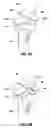 Fig. 09 - Method and implant for securing ligament replacement into the knee