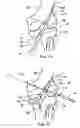 Fig. 11 - Method and implant for securing ligament replacement into the knee